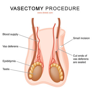 Vasectomy Image
