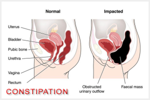 Constipation Image