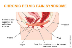 Chronic Pelvic Pain Syndrome Image