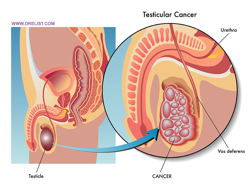Testicular Cancer Image