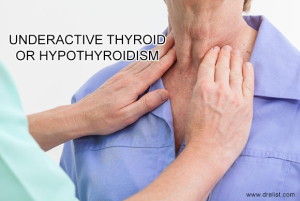 Hypothyroidism Image