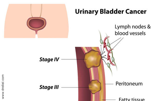 Prevention of Bladder Cancer