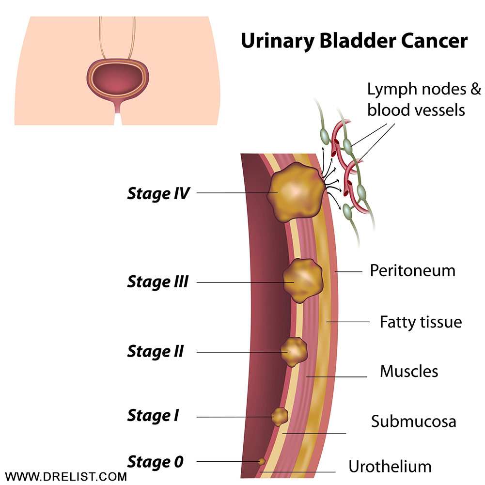 Bladder Cancer Stages  Image