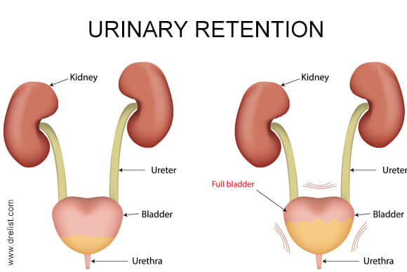 Urinary Retention