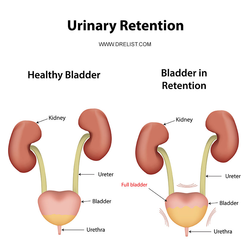 Urinary Retention Image