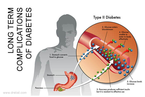 Long Term Complications of Diabetes