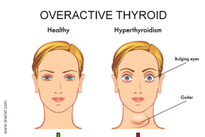 Overactive Thyroid Image