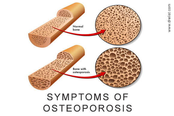 Symptoms of Osteoporosis
