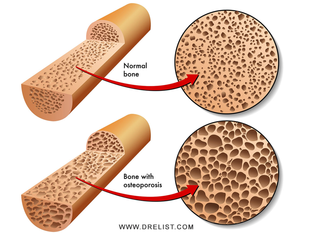 Symptoms of Osteoporosis Image