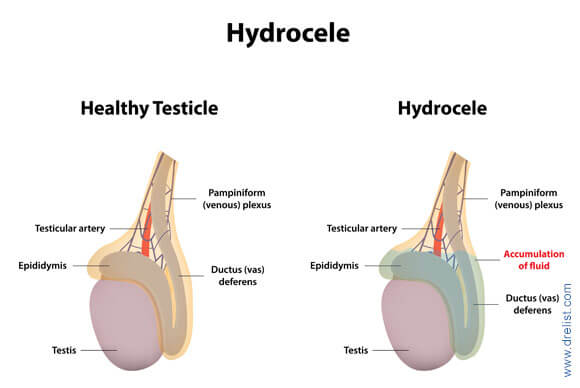 Hydrocele Symptoms, Causes and Treatment