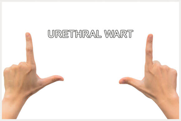 Urethral Wart