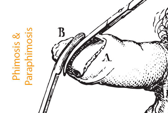Phimosis and Paraphimosis