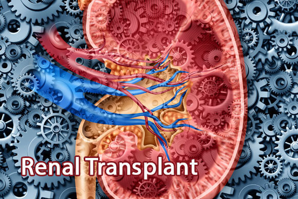 Renal Transplant