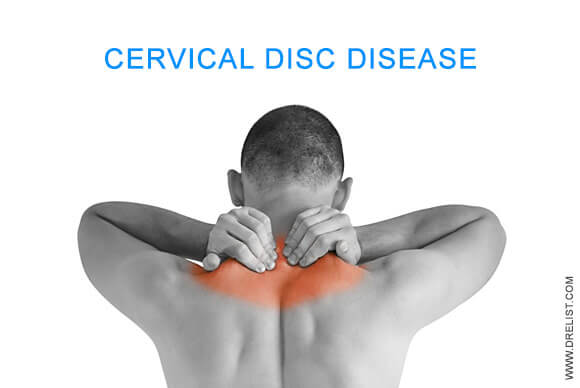 Cervical Disc Disease