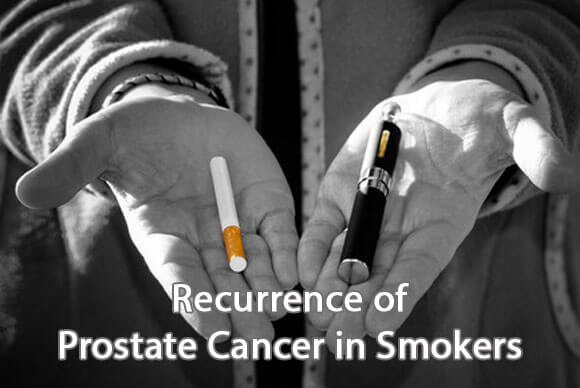Recurrence of Prostate Cancer in Smokers