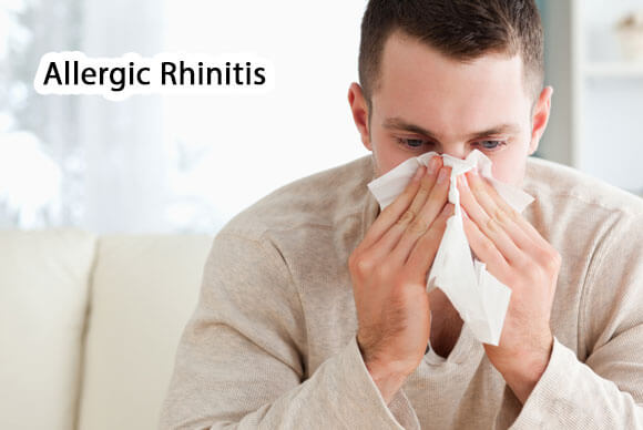 Allergic Rhinitis