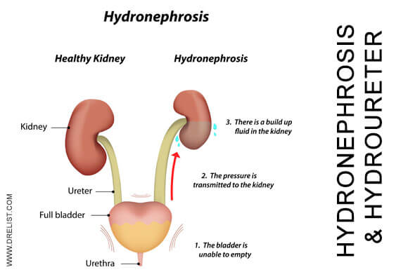 Hydronephrosis and Hydroureter