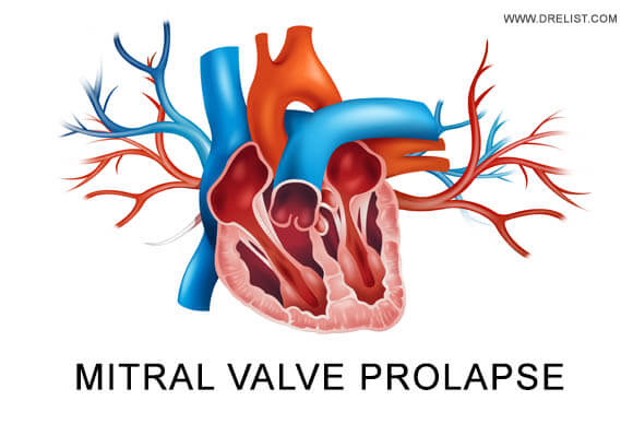 Mitral Valve Prolapse