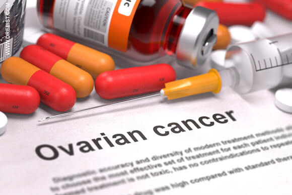 Ovarian Cancer