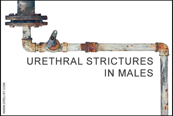 Urethral Strictures in Males