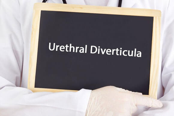 Urethral Diverticula