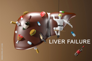 Liver Failure image