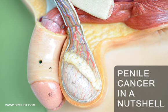 Penile Cancer in a Nutshell