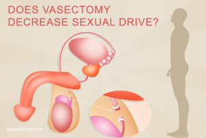 Does Vasectomy decrease sexual drive? image