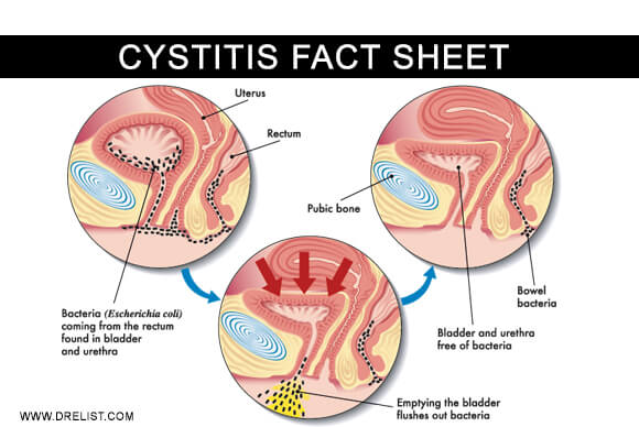 Cystitis Fact Sheet