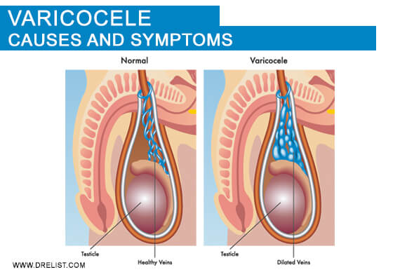 Varicocele: Causes and Symptoms