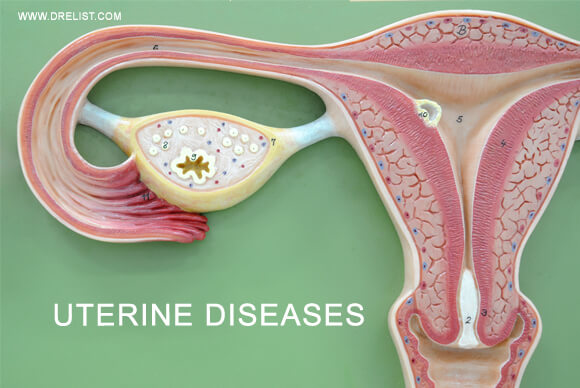 Uterine Diseases