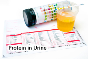 Protein in Urine Image