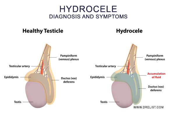 Hydrocele: Diagnosis and Symptoms