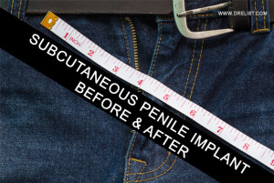 Subcutaneous Penile Implant Before & After image