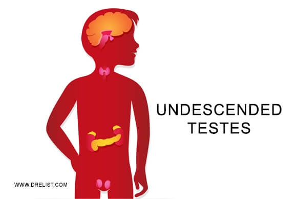 Undescended Testes