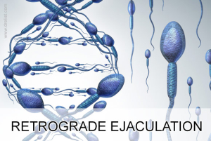 retrograde ejaculation image