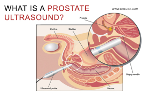 What Is A Prostate Ultrasound? image