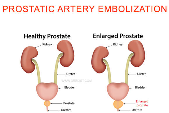 Prostatic Artery Embolization