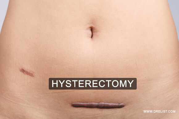 Hysterectomy