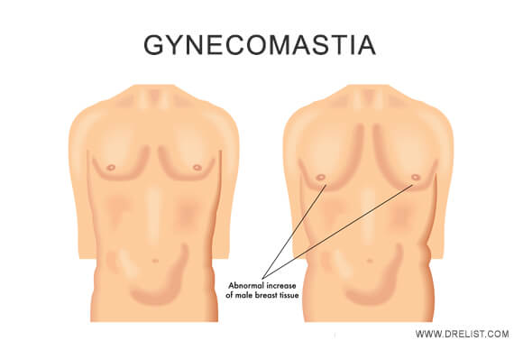 Gynecomastia