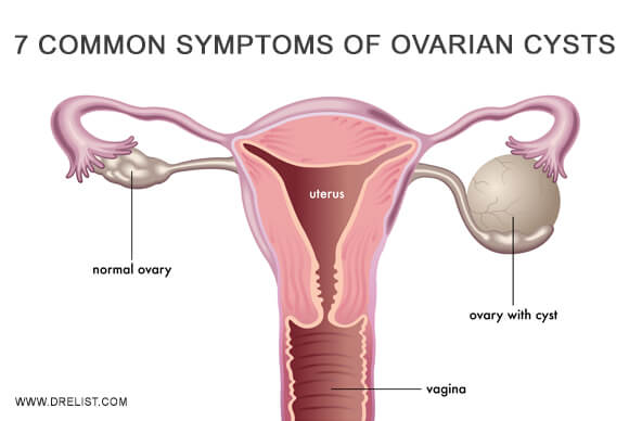 7 Common Symptoms Of Ovarian Cysts