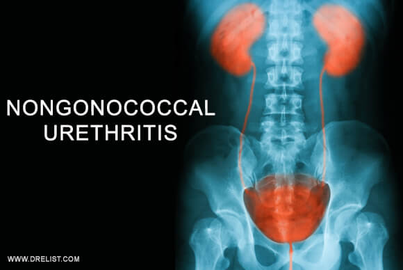 Nongonococcal Urethritis
