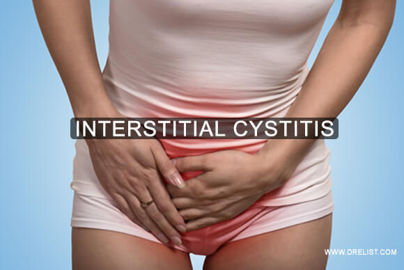 Interstitial Cystitis