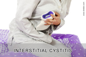 Interstitial Cystitis Image