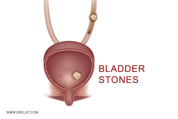Bladder Stones