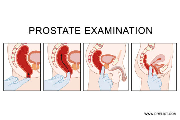 Prostate Examination