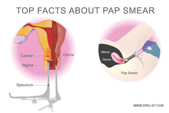 Top Facts About Pap Smear