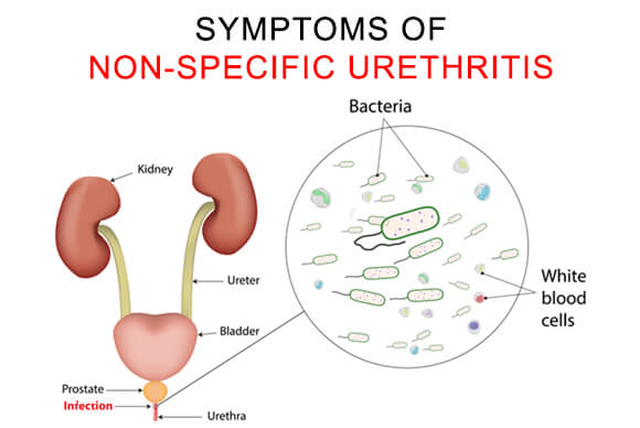 Symptoms Of Non-Specific Urethritis
