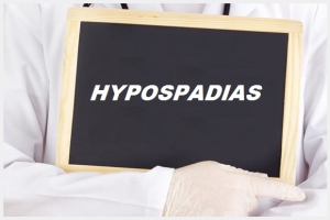 Hypospadias Image