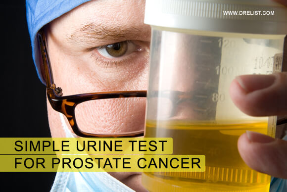 Simple Urine Test For Prostate Cancer Diagnosis